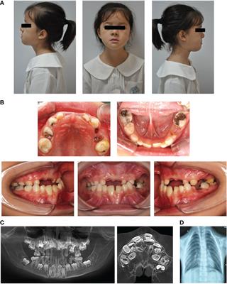 Amyloid-mediated remineralization for tooth hypoplasia of cleidocranial dysplasia